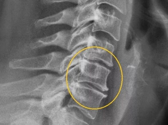 Bizkarrezurreko bizkarrezurraren osteokondrosia x -Ray batean