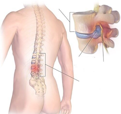 Erradikalitoa hanturazko prozesua da lumbosacral sailean