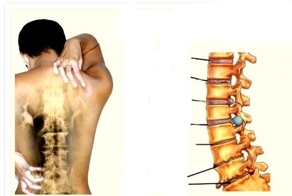 Osteokondrosia bizkarreko minaren kausa da