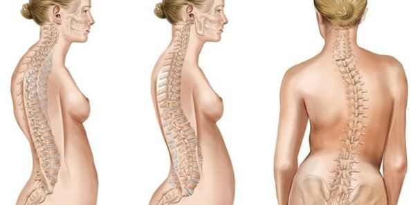 Scoliosis-Disko intervertebralen nahasketa